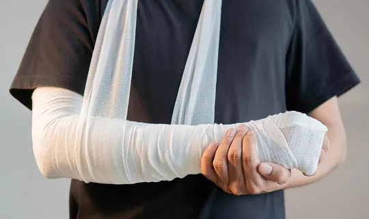 Person wearing black shirt with left arm in white medical cast and sling.